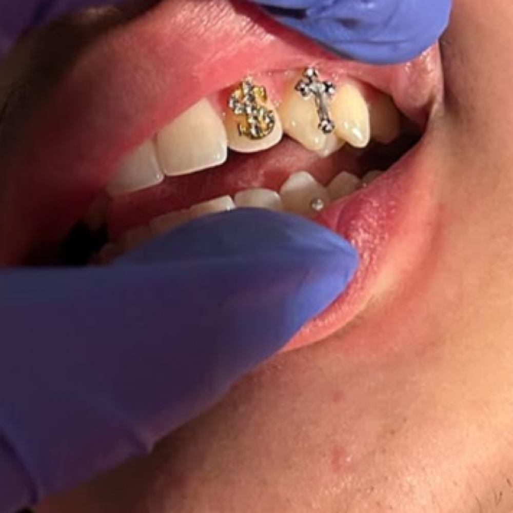 Permanent Tooth Gems at Melt. The Body Bar in Lakewood, CO
