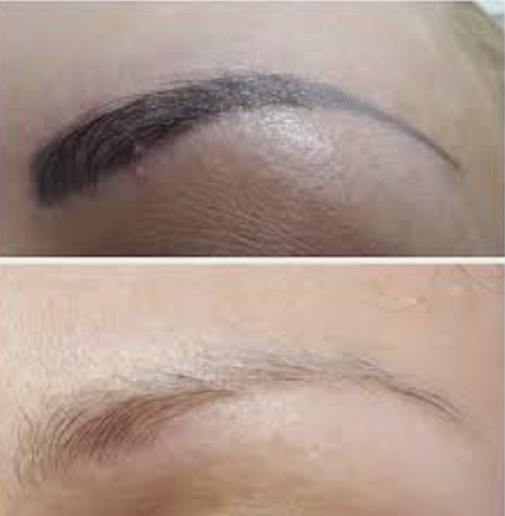 Removal  of permanent makeup