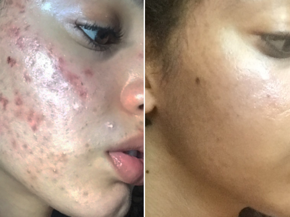 Teen Clean Facial