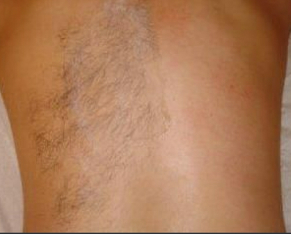 Stomach Hair Removal