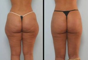 Ultra Sonic Fat Burn Cavitation