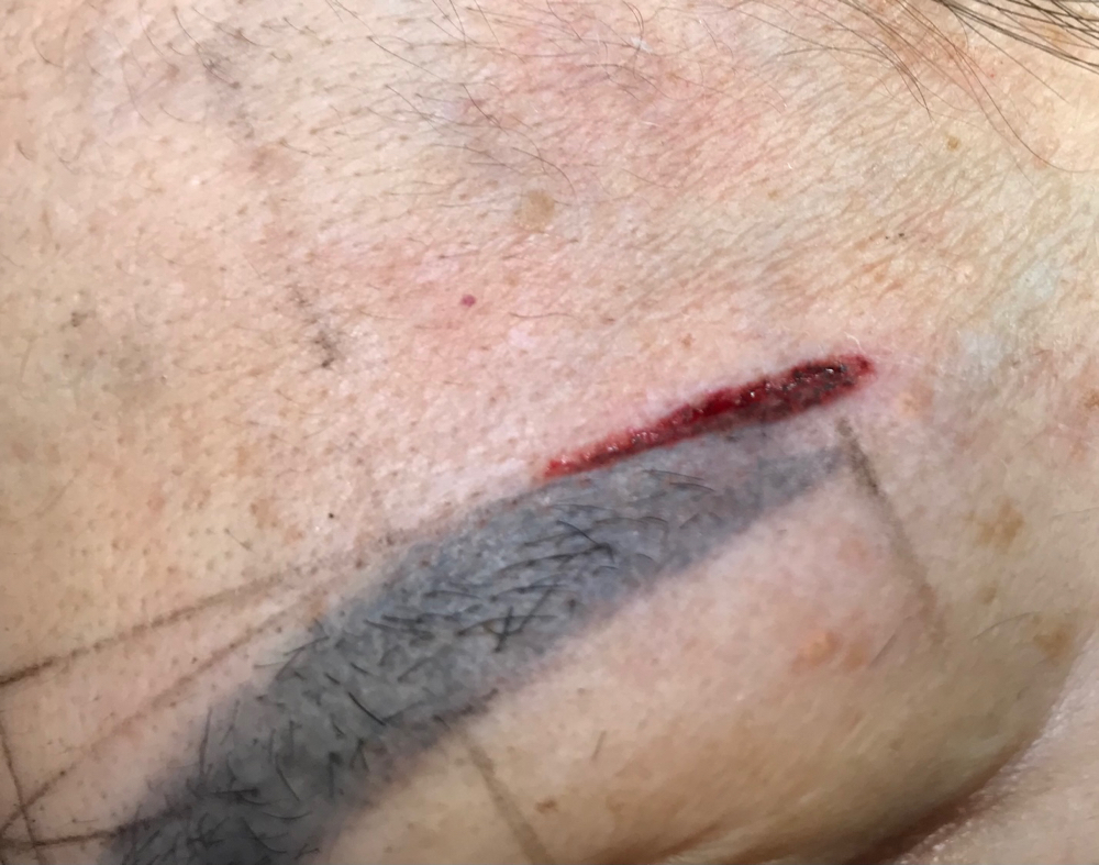 PMU/Saline Tattoo Removal