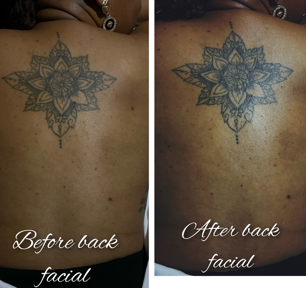 Detoxifying  Back Treatment