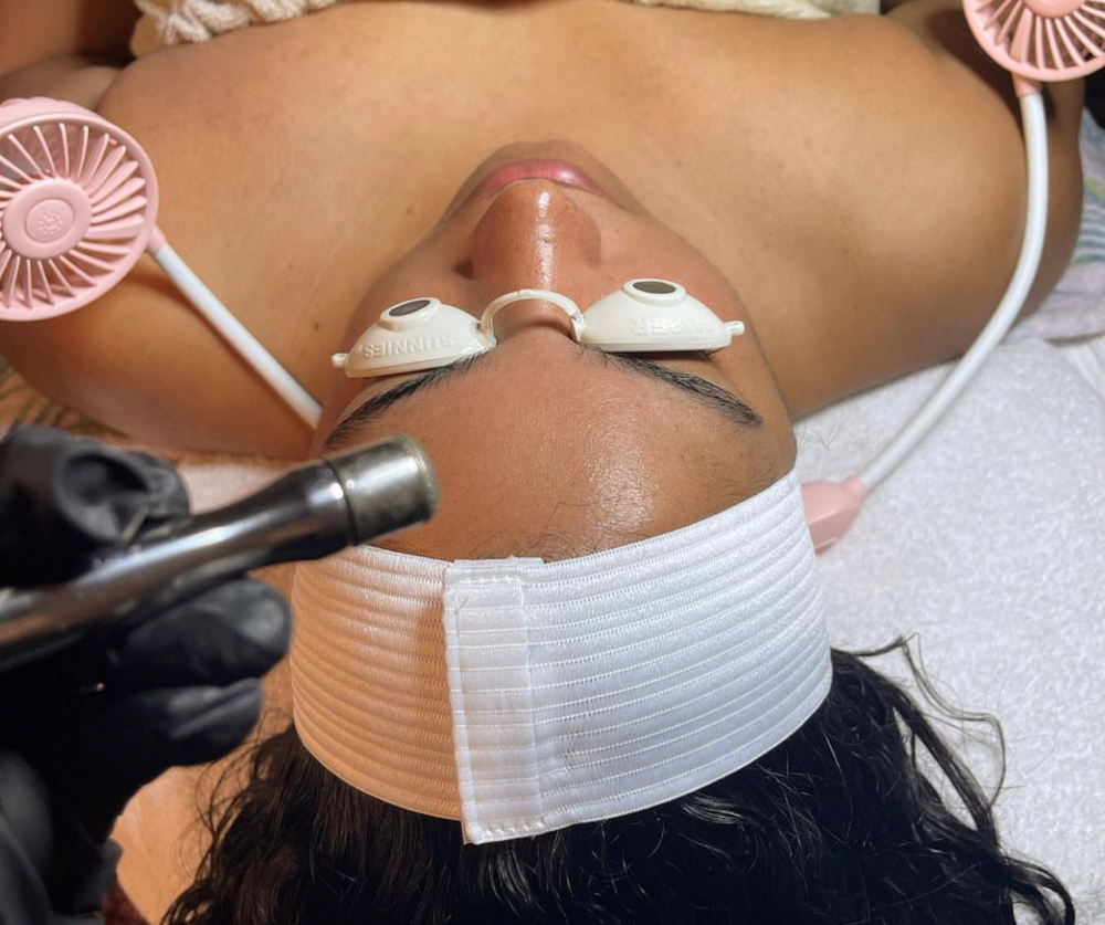 Microdermabrasion Facial