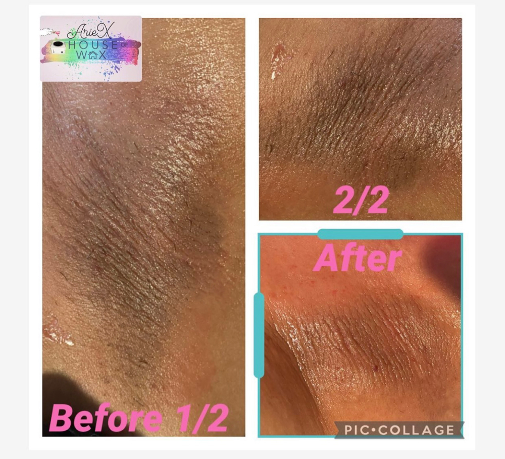 Armpit-peel/Despigmentacion Axilas