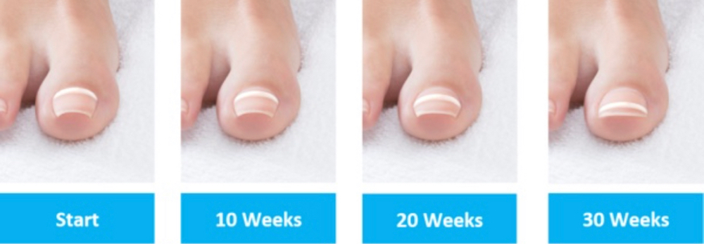 ONYFIX TOENAIL CORRECTION