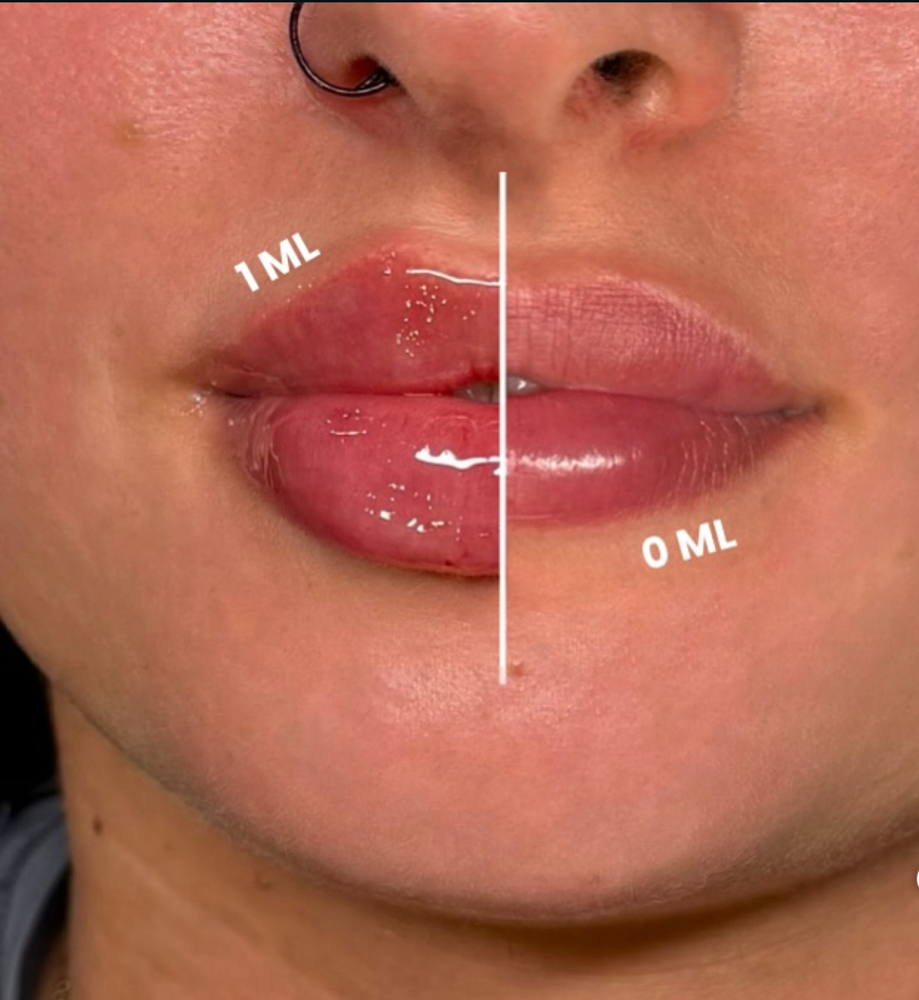 $50 OffLipfiller 1st Time Clients