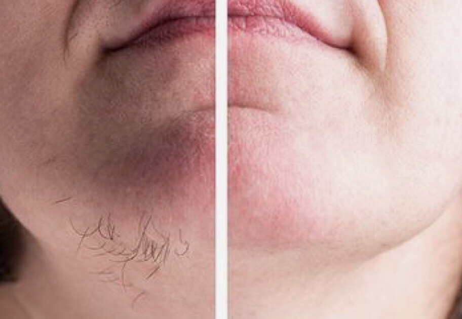 Chin Wax
