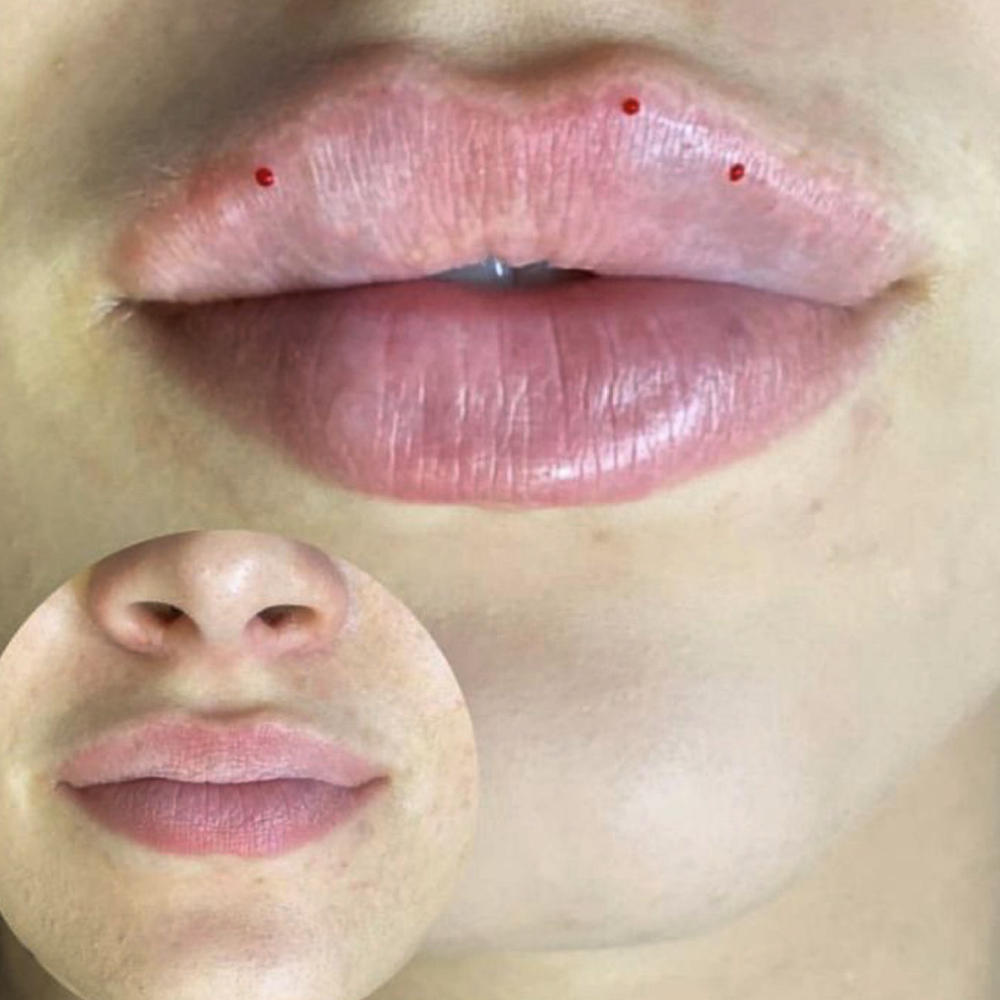Lip Filler