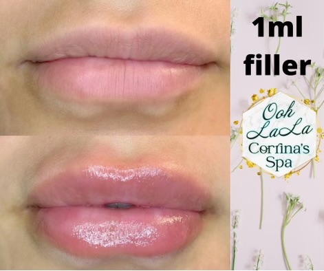 Full Syringe (needless Filler)