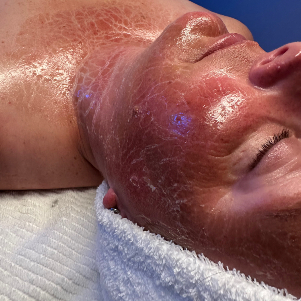Rewind Facial at esthetically yours, corley in Brookhaven, MS