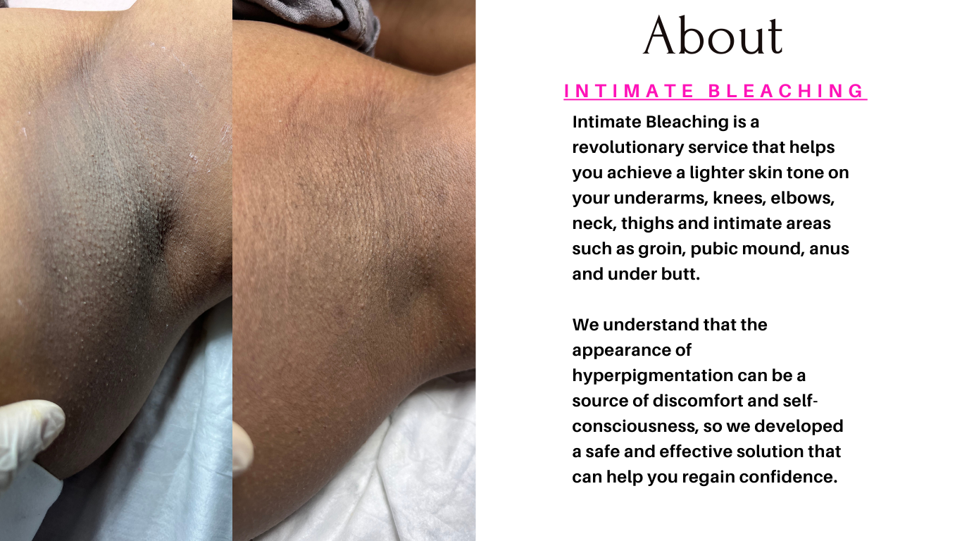 Intimate Bleaching  (3 Session)