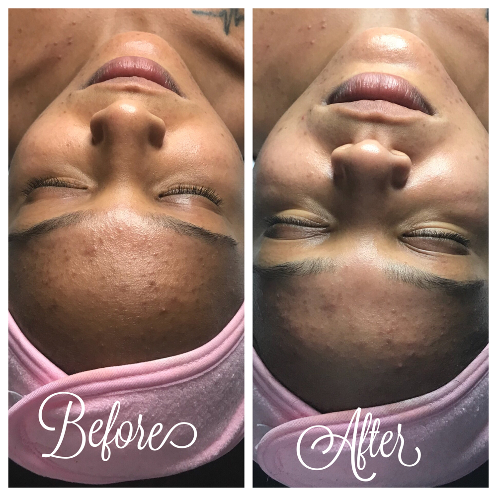 Deep Pore Cleansing Facial