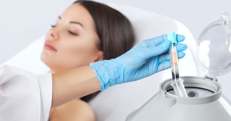 Microneedling With PRP