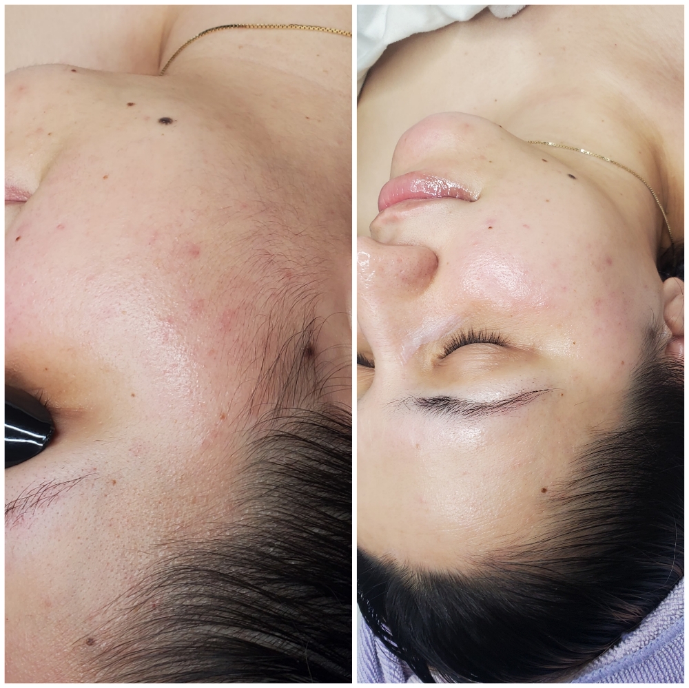 Dermaplane Bespoke Facial