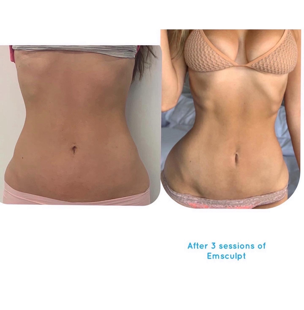Emsculpt Special at Glass Skin Bar in Chicago, IL