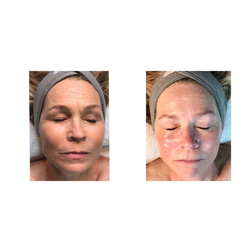 Skin Rejuvi- Face & Neck(1 Session)