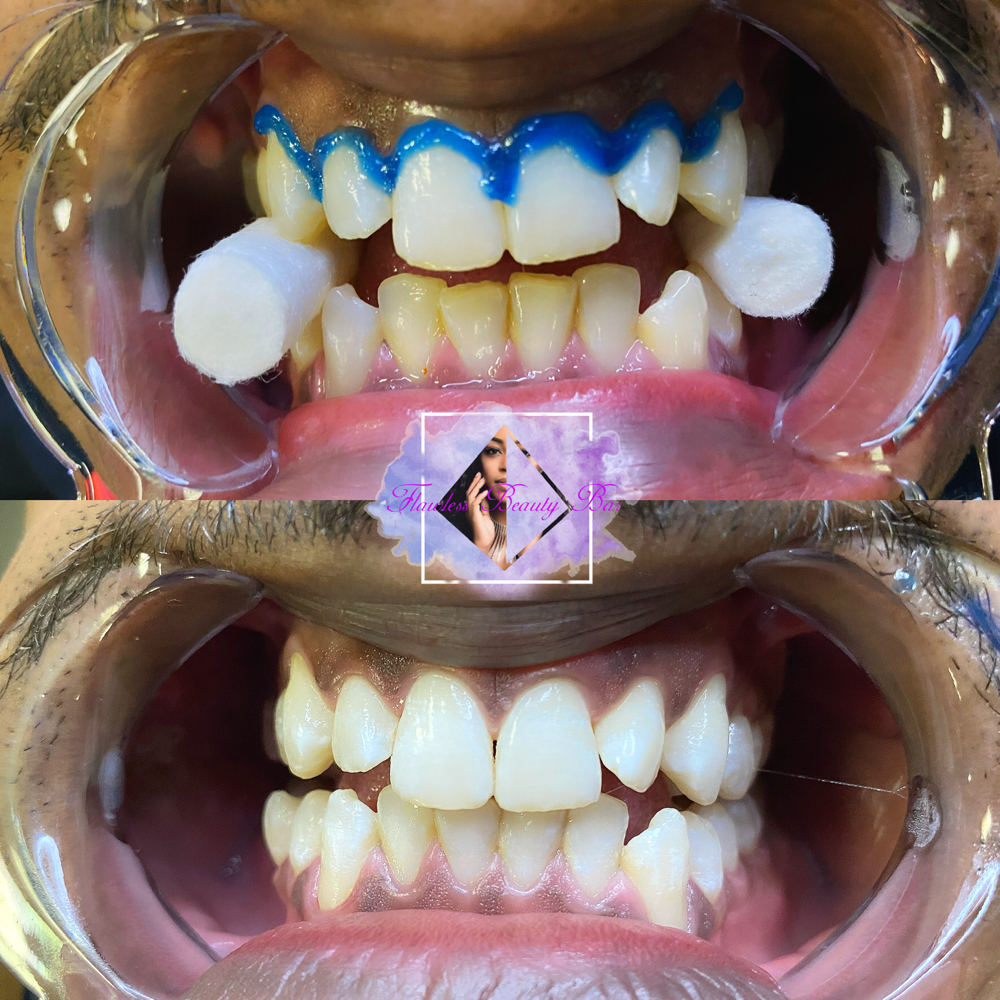 Teeth Whitening