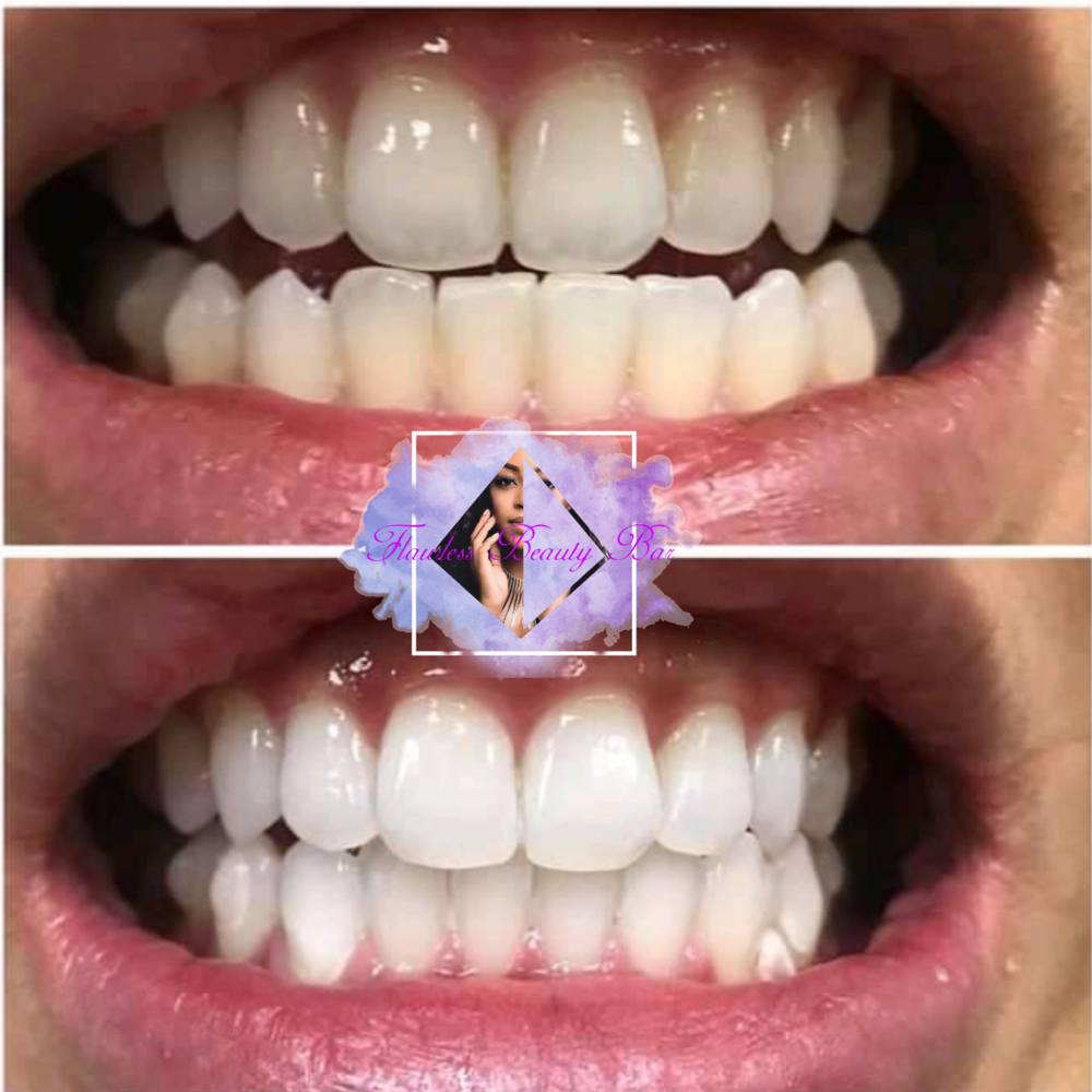 Ultra Teeth Whitening