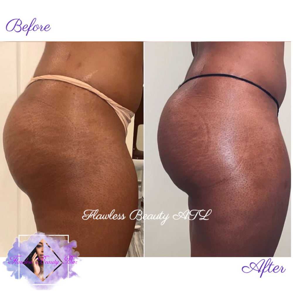 Non Invasive Butt Enhancements