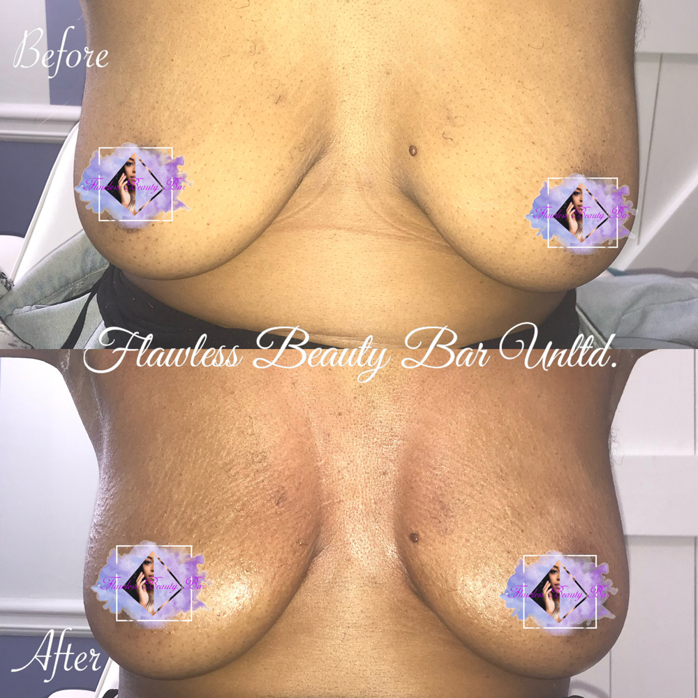 Non Invasive Breast Enhancement