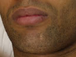 Chin- Men
