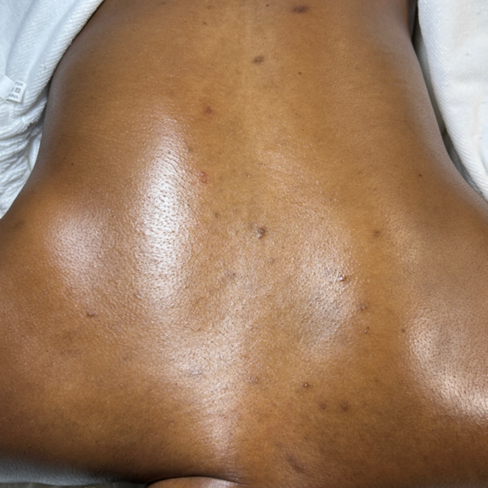 BACK FACIAL at Prime Skin  Esthetics in Belleville, NJ