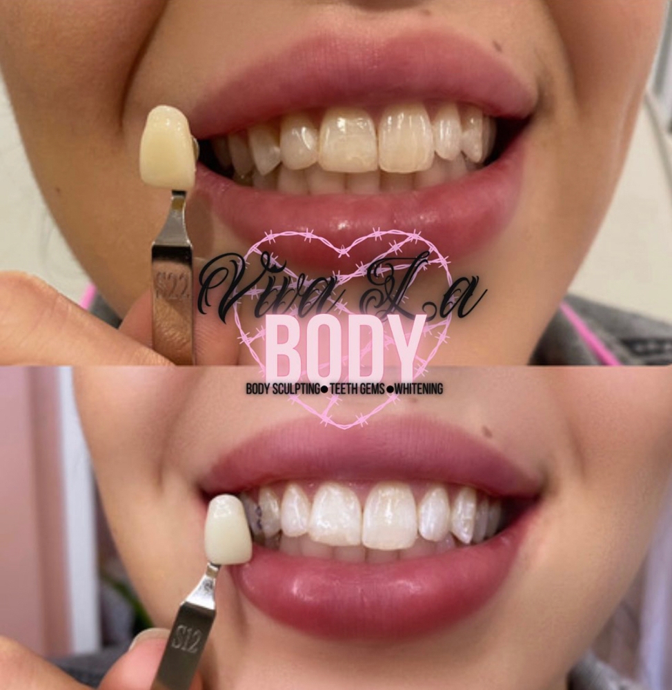 30 Minute Teeth Whitening Session