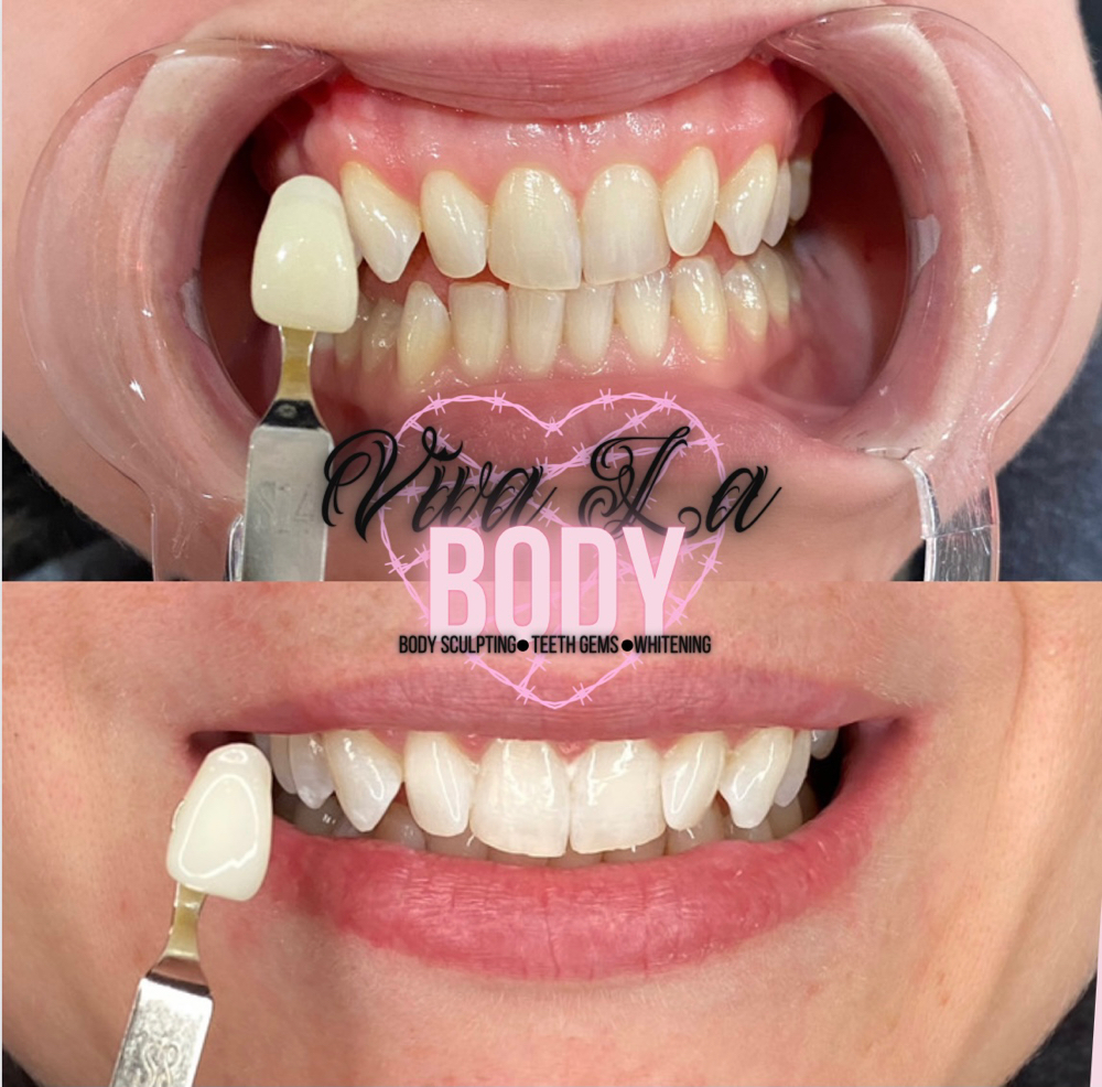 90 Minute Teeth Whitening Session