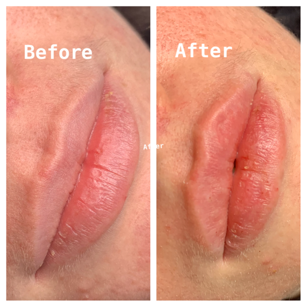 Lip Filler