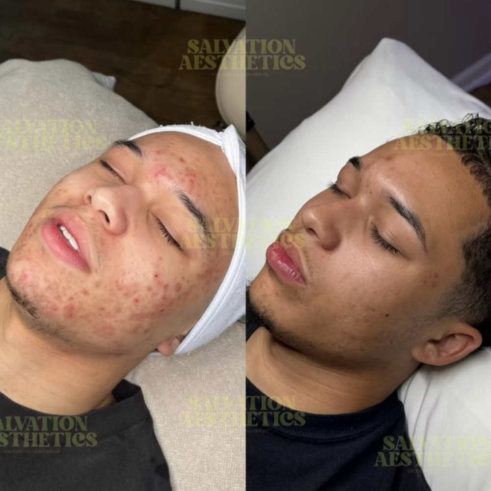 Face Reality Acne Bootcamp at Salvation Aesthetics in Kenosha, WI