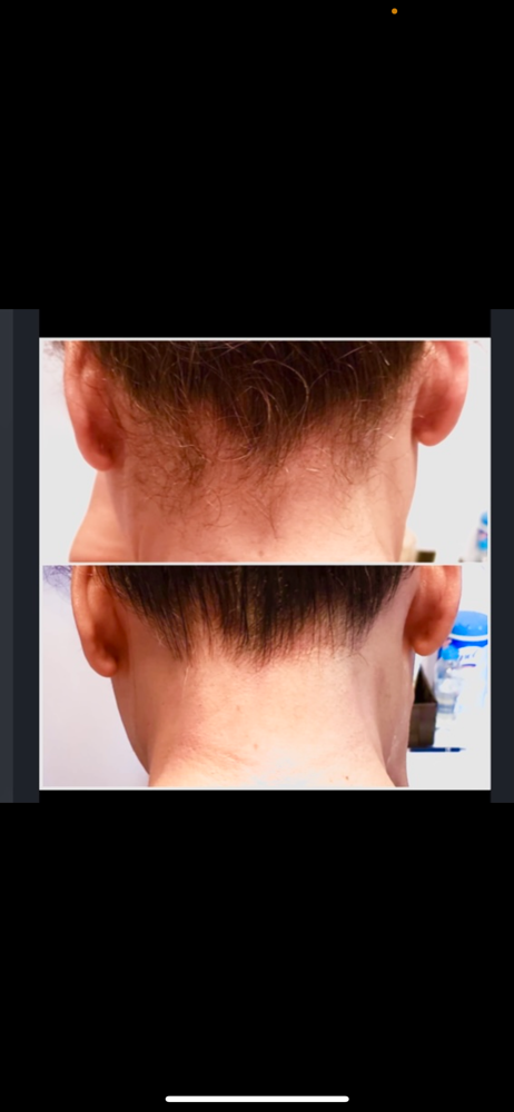Hair Line