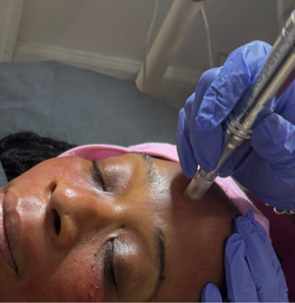 Microneedling Treatment at Zen Essence Spa & Wellness in Brooklyn, NY