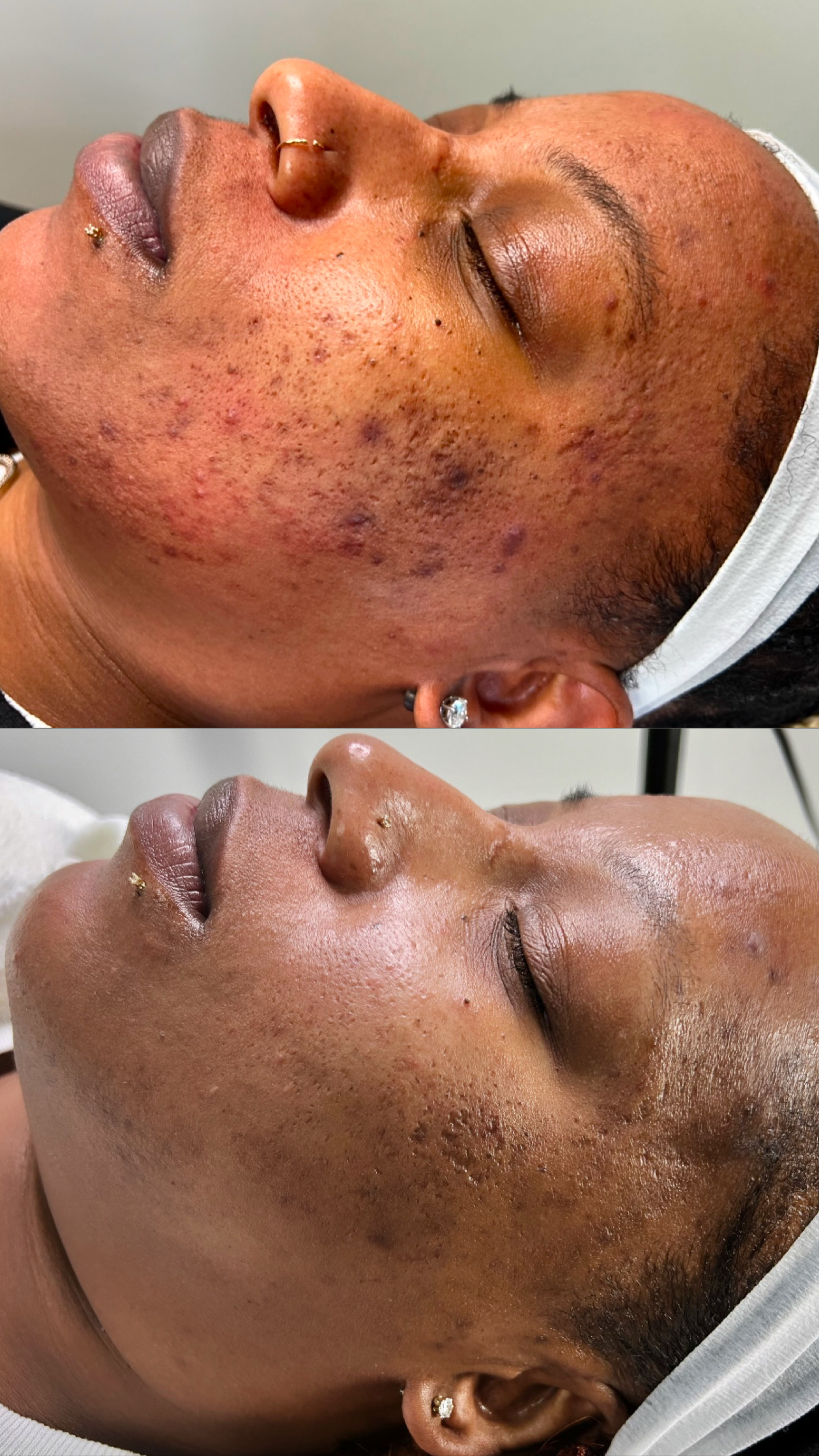 MICRONEEDLING w/ PRP at FIRMÉ SKIN in Columbia, MD