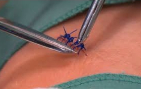 Suture Removal or Drains