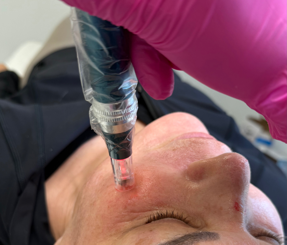 Microneedling