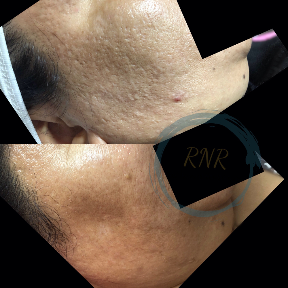 Medi MicroNeedling