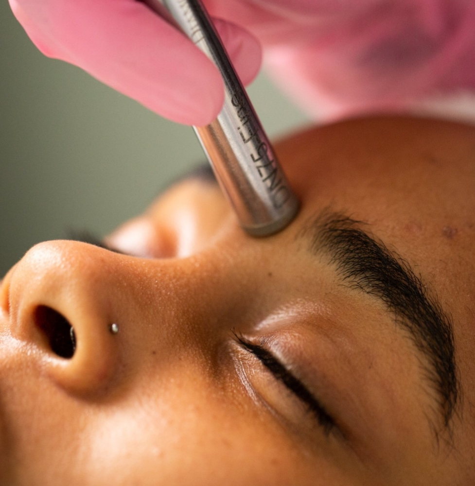 MicrodermAbrasion