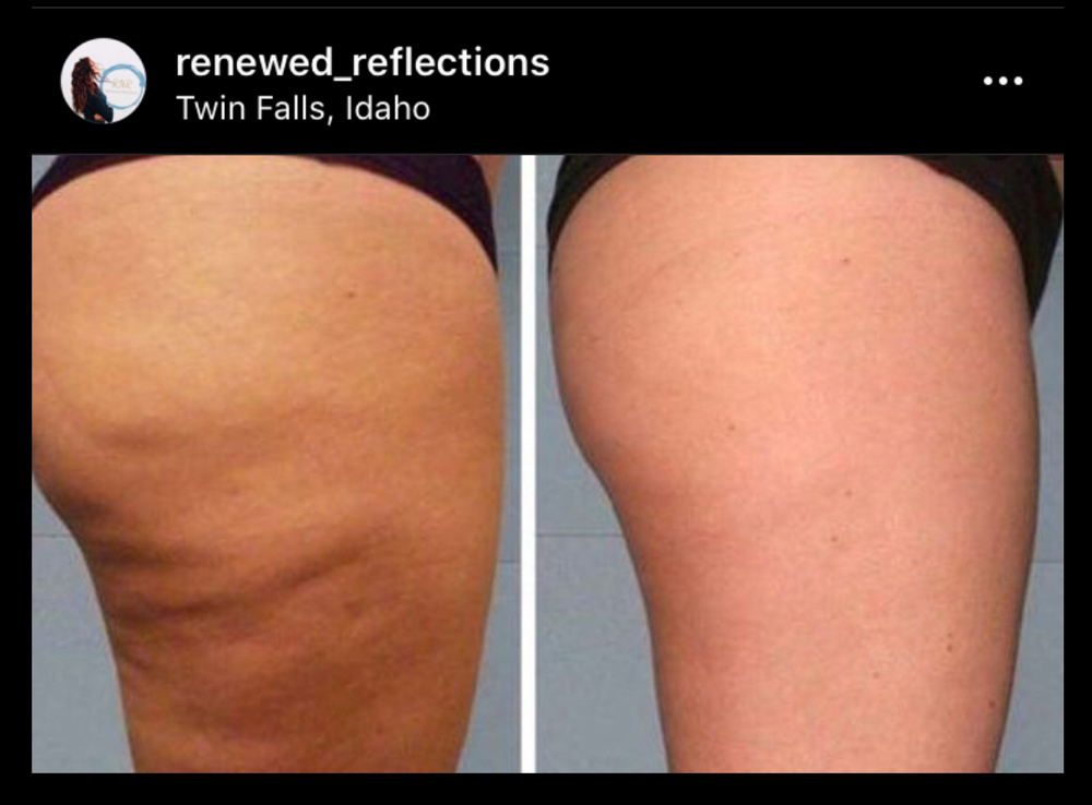 Cellulite Treatment