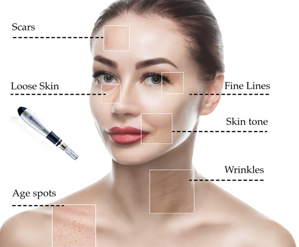 Microneedling package Of 3 $885