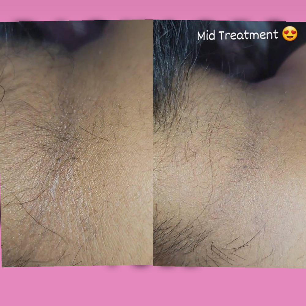 Neck Skin Correction