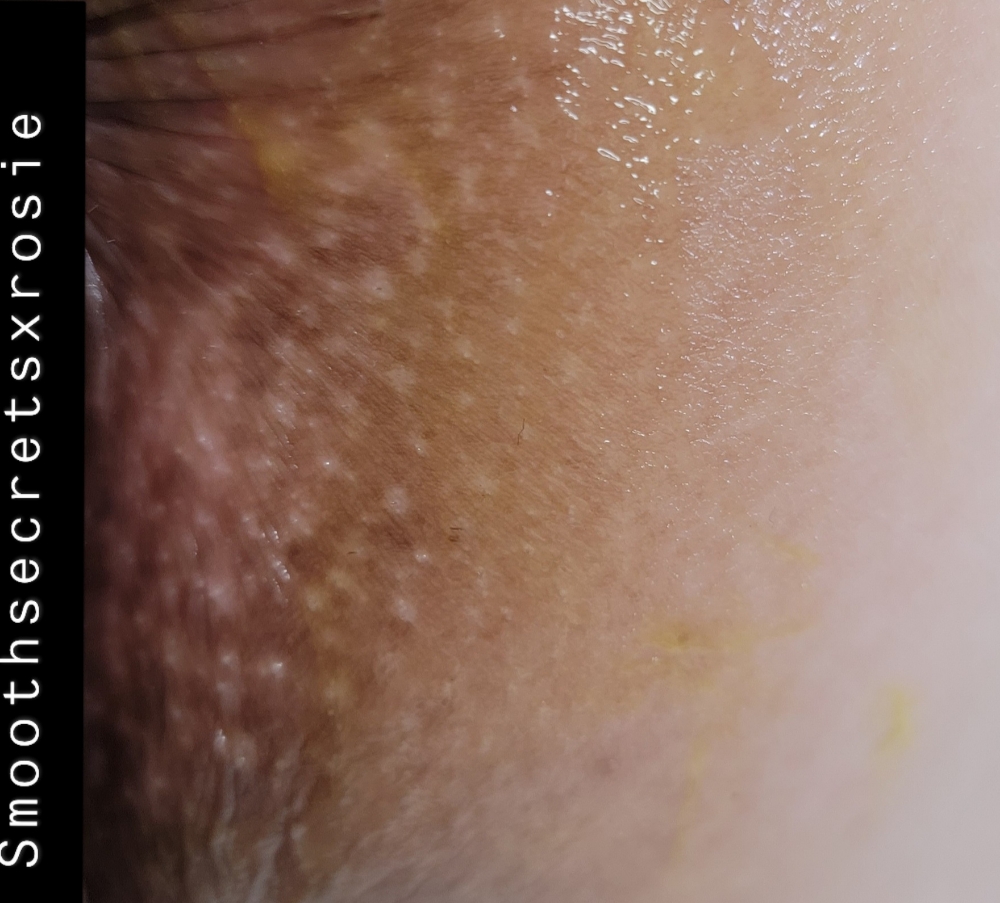 Anal Skin Correction
