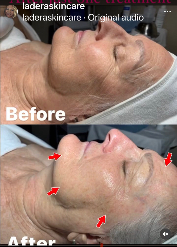 Sculplla "No Needle" Facial Filler