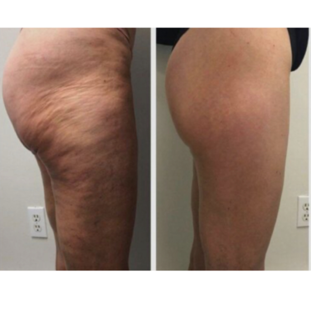 Lipedema Supportive Therapy at Vida Wellness in Suite 206  #129, CA