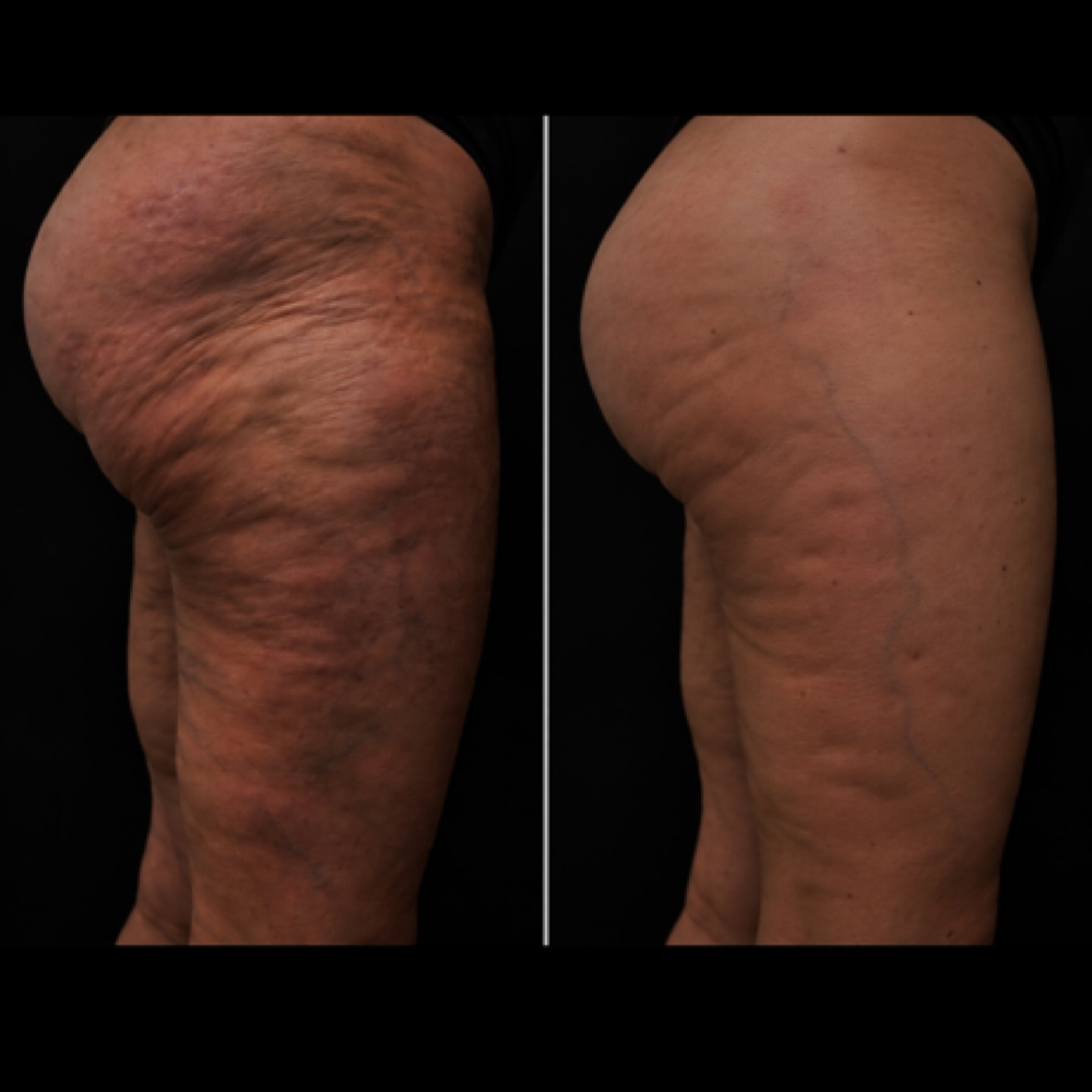 Lipedema Supportive Therapy at Vida Wellness in San Diego, CA