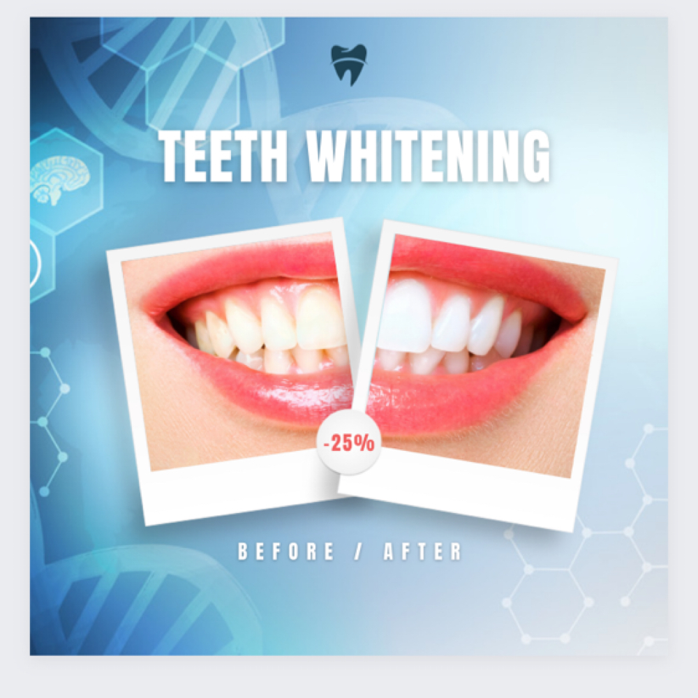 120 Min Teeth Whitening Session at iGlow Skin Solutions LLC in Eatontown, NJ