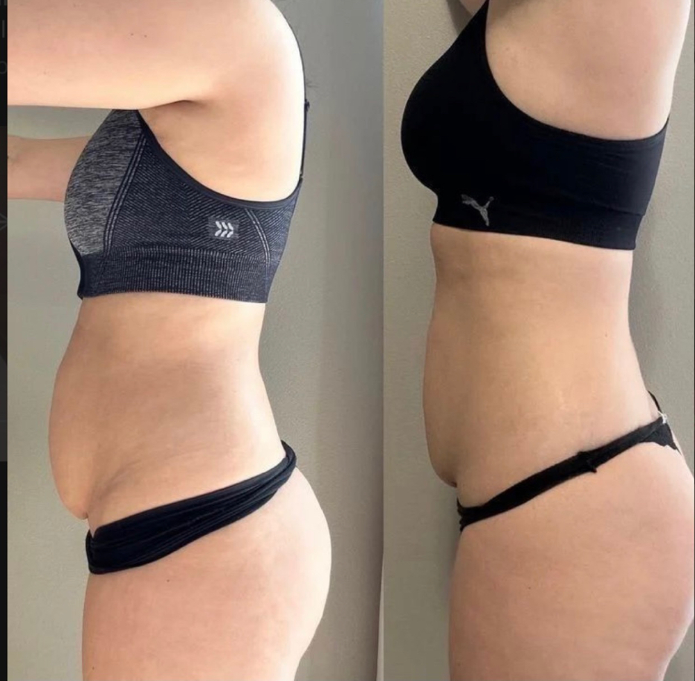 Ultrasonic Cavitation (Body Contouring)