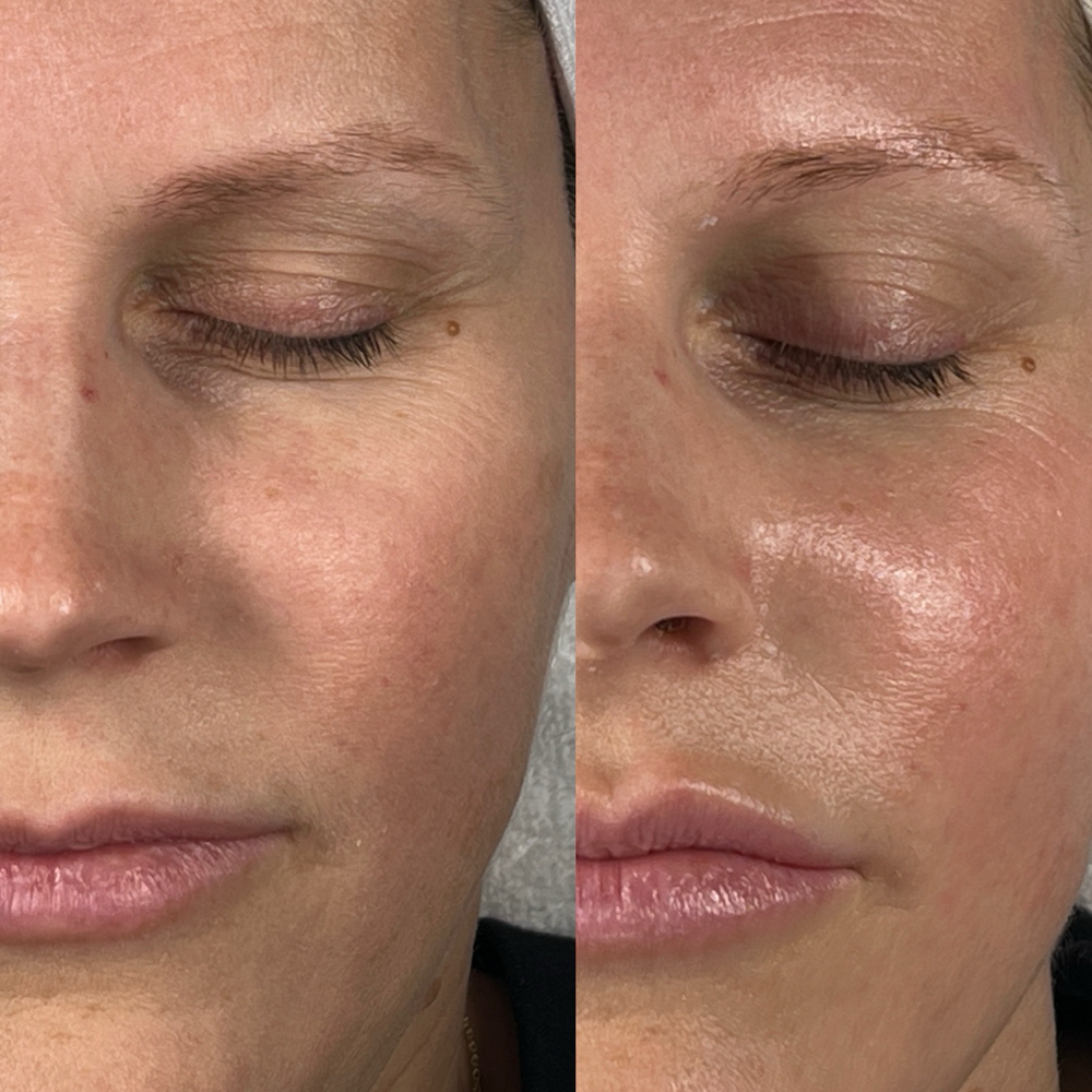 Nano Infusion Facial (Basic) at Illuminate Lashes and Beauty in Trussville, AL