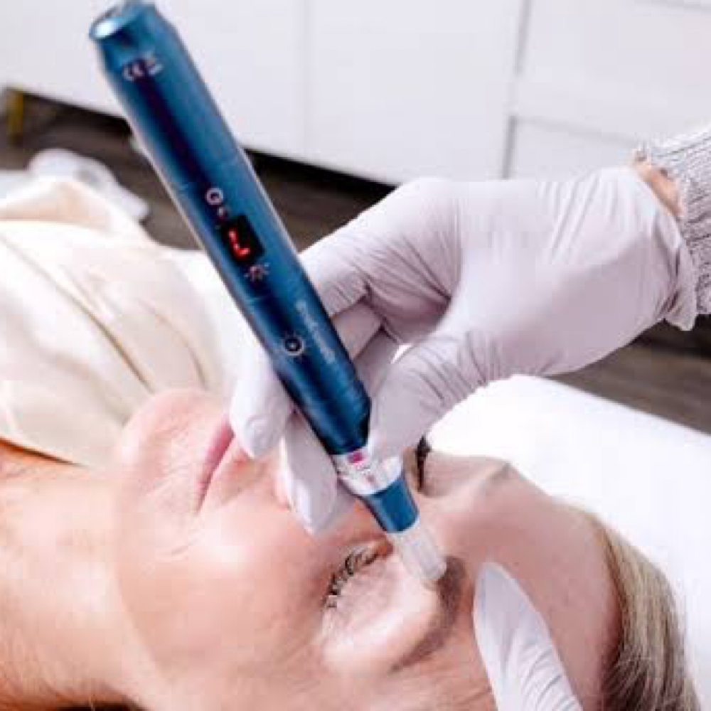 Microneedling at Blackbird PMU & Esthetics in Harrisburg, NC