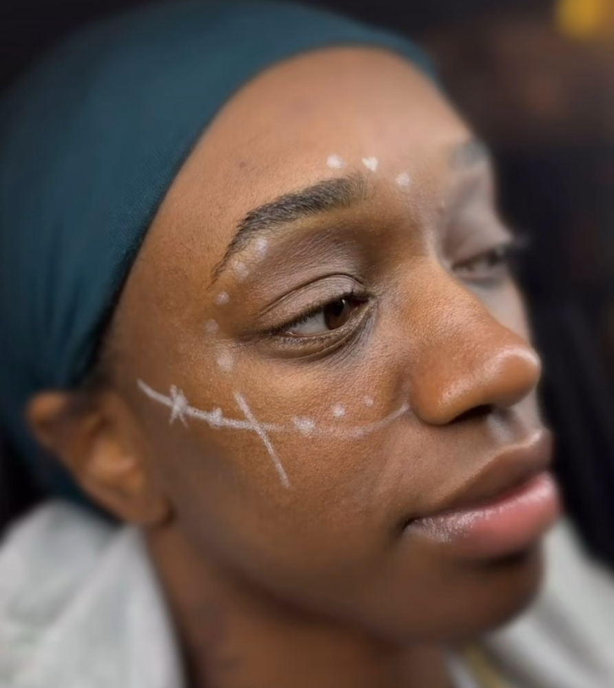 Brow Lift